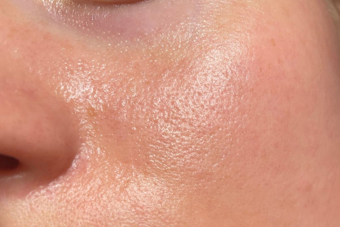 Why You NEED to Use Mineral Sunscreen for Oily Skin